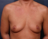 Feel Beautiful - Breast Augmentation Case 45 - Before Photo